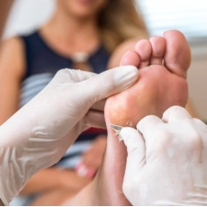Corns and Calluses