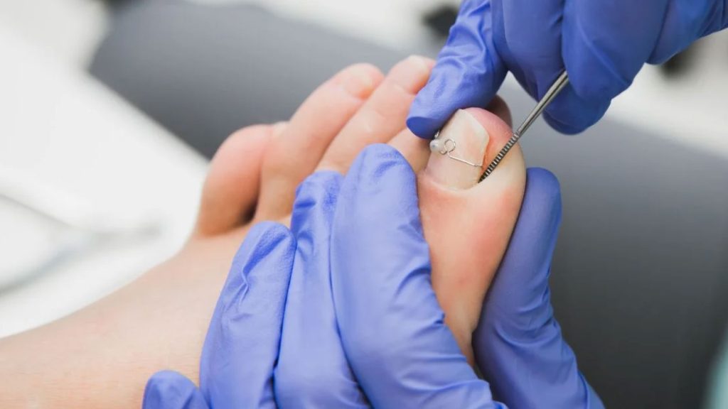 Nail Brace -1