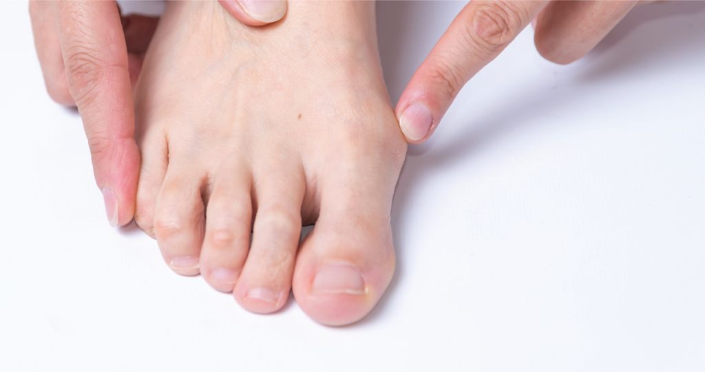 Bunions Understanding and Preventing 1