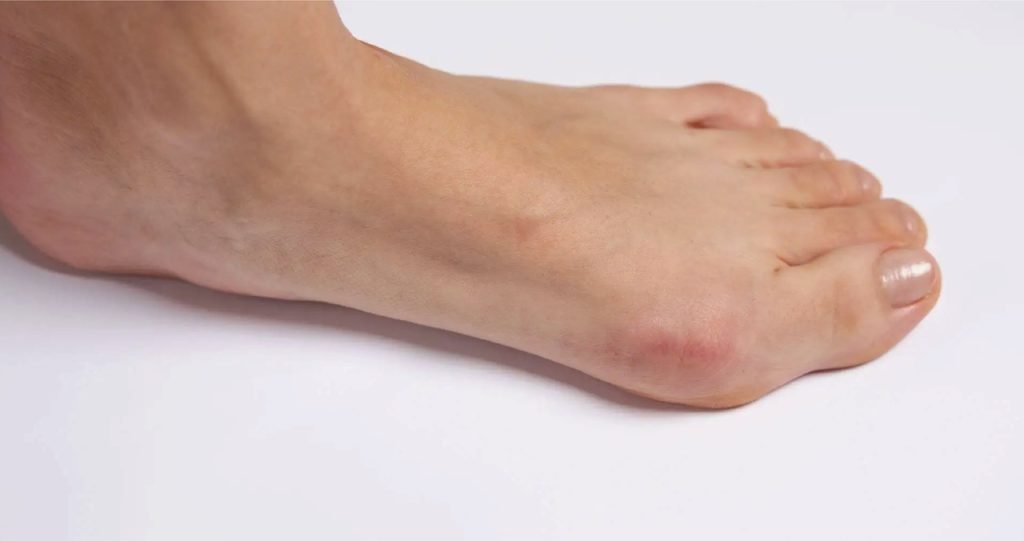 Bunions Understanding and Preventing 2