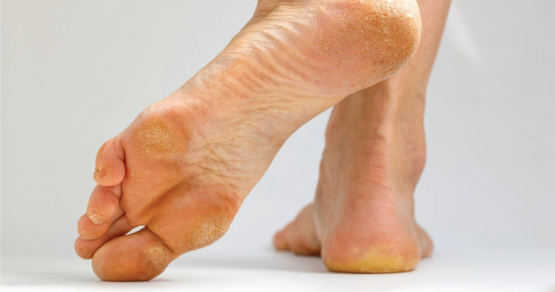 Corns and Calluses 1
