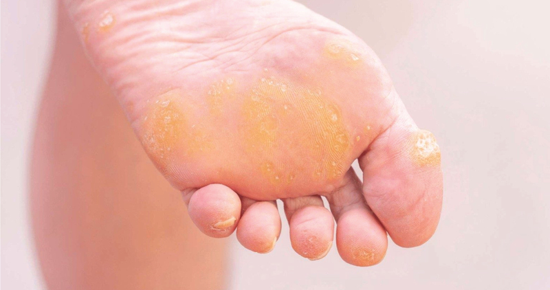 Corns and Calluses 2