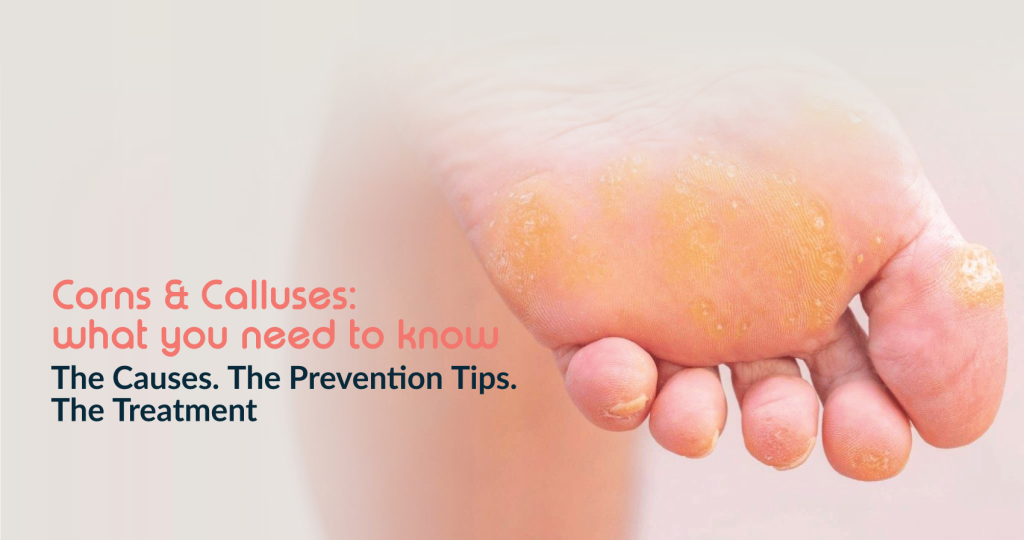Corn and Calluses