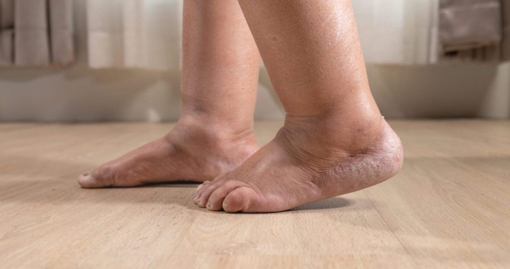 Swollen Feet 1